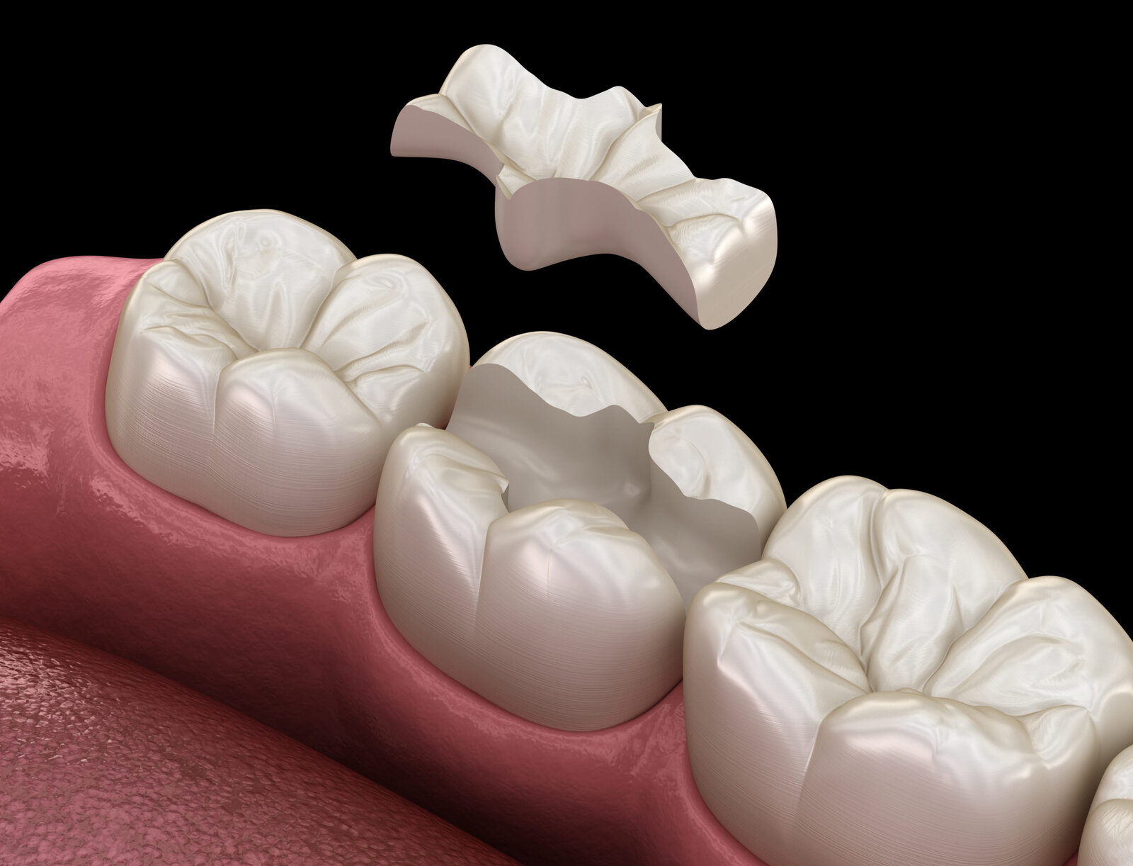 Illustration 3D d'un onlay