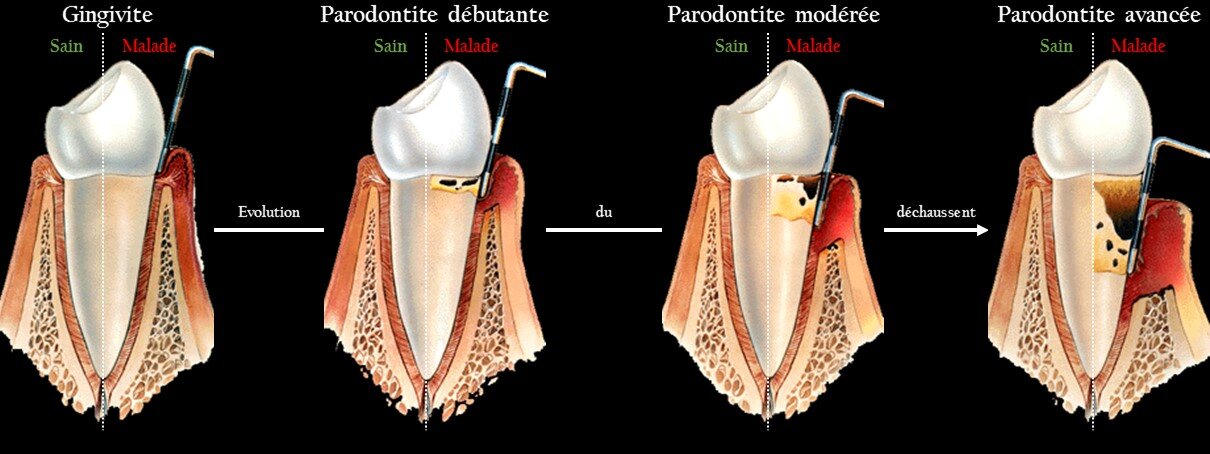 Illustration d'une gencive saine ou atteinte